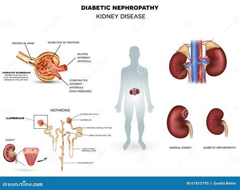 Nefropatia Do Diab Tico Doen A Renal Ilustra O Do Vetor Ilustra O