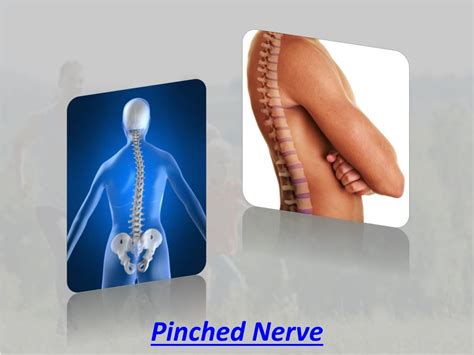 Ppt Pinched Nerve Powerpoint Presentation Free Download Id757358