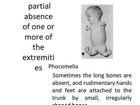 Development Of Upper Limb And Its Congenital Anomalies Ppt Video Online