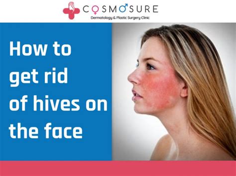 How To Get Rid Of Hives On Face Cosmosure Clinic