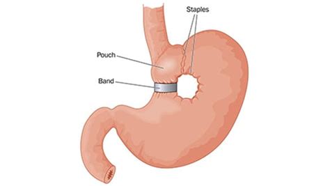 Gastric Band Surgery - Sleeve Center