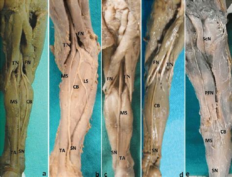 Origin Of The Sural Nerve SN A SN Consists Of Medial Sural