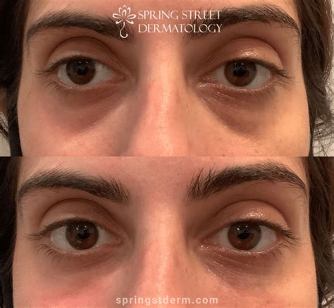 Botox Vs Fillers Which One Is Better Spring Street Dermatology