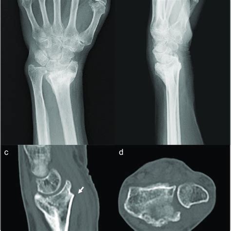 A And B Posteroanterior And Lateral View Radiographs Of The Left Wrist