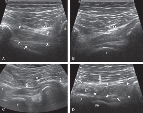 Hip And Thigh Ultrasound Radiology Key