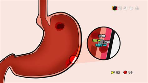 위염위궤양의 원인 ‘헬리코박터 파일로리 홍삼으로 극복할 수 있다 건강프라임 시선뉴스