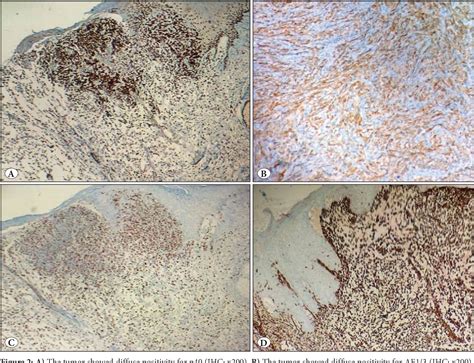 Figure From Primary Cutaneous Myxoid Spindle Cell Squamous Cell