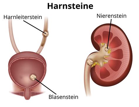 Nierensteine Symptome Behandlung Entfernung