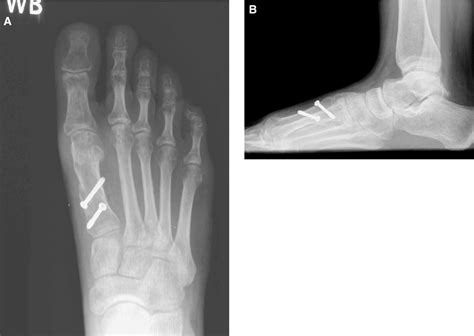 Figure From Clinical Results With The Ludloff Osteotomy For