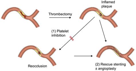 Frontiers Endovascular Treatment Of Acute Stroke Due To Intracranial