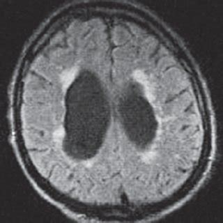 Leukoaraiosis on T2-weighted MRI. Magnetic resonance | Download Scientific Diagram