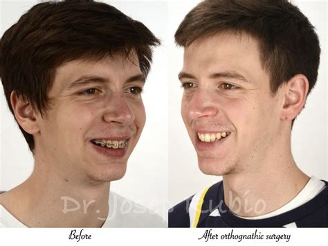 Cirug A Maxilofacial Antes Y Despu S Multiestetica