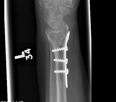 Distal Radius Fracture The Bone School