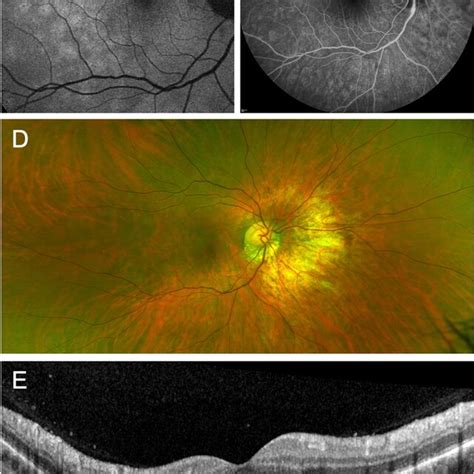 Multimodal Imaging Patient 21 Demonstrates The Importance Of