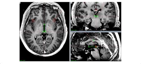 Lead Location Postoperative Computed Tomography Images Fused With