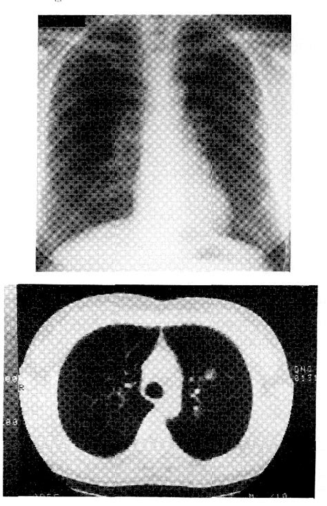 Figure 1 From A Resected Case Of Recurrent Pulmonary Sclerosing