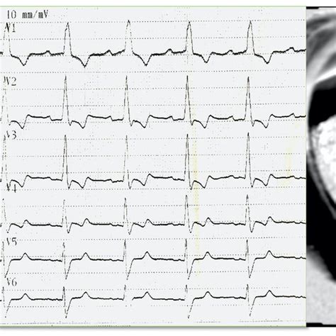 Cardiac Amyloidosis Ecg Showing Significant 1st Degree Av Block And