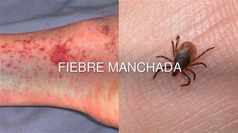 Fiebre Manchada Adrianah Valenchy Udocz