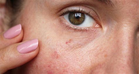 Spider Veins On Your Face Causes Treatment And Prevention Activebeat