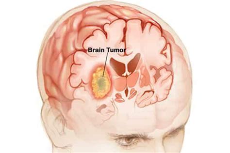 What is Brain Tumor?