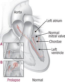 Heart Murmur Guide Causes Symptoms And Treatment Options