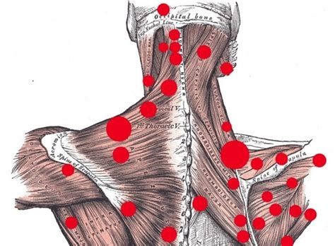 Trigger Points Therapy Nei Nostri Centri Di Milano E Piacenza Laltra