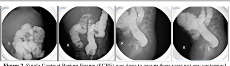 Figure 2 From Colon Interposition As Esophageal Replacement In Long Gap