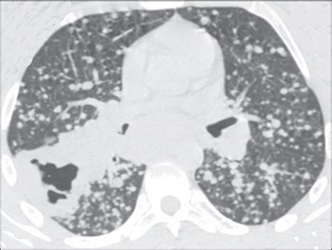 Scielo Brasil Computed Tomography Findings Of Pulmonary