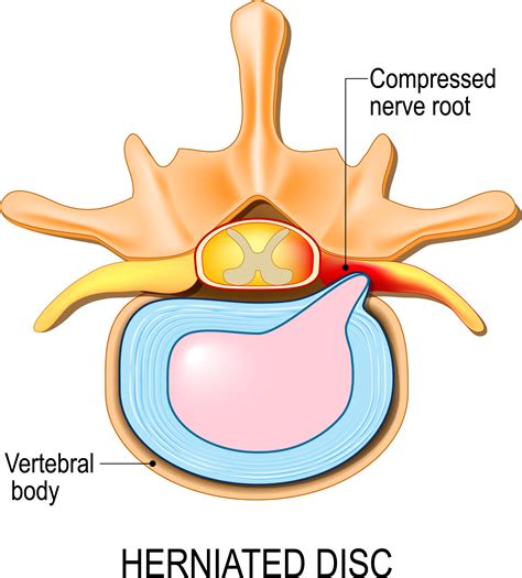 Pinched nerve | AllSpine