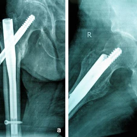 A 3 Months Post Surgery Anteroposterior Radiographic View Showing Full