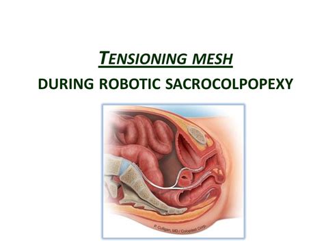 Mesh Tensioning During Robotic Sacrocolpopexy Youtube