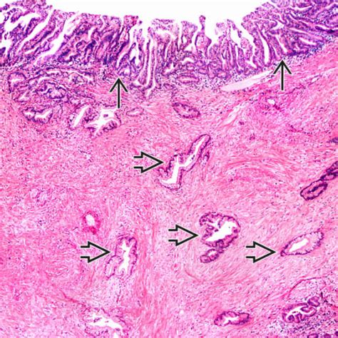 Intraductal Papillary Mucinous Neoplasm Basicmedical Key