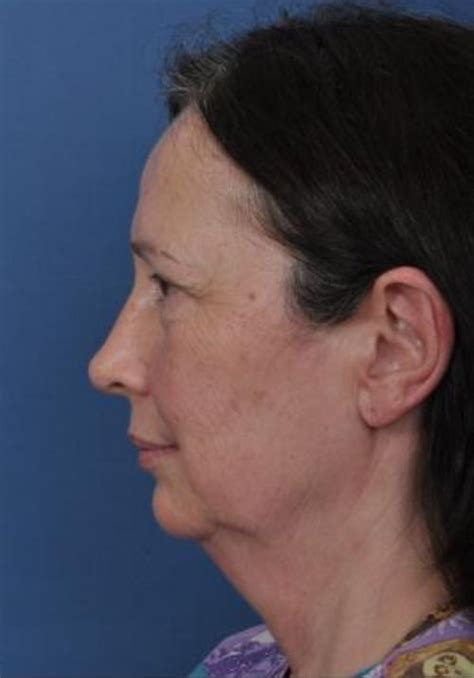 Facelift Mid Cheek Lift Case 1449 Plastic Surgery In Memphis TN