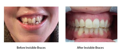 Invisible Braces - Dental 397 | Dentist in Exeter, Devon