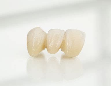 Dental Bridge Types Benefits Use Case And Costs