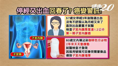 停經後出血不是回春！子宮內膜增厚小心癌變 「四草湯」清熱、解毒又止血月經婦癌子宮內膜癌｜健康20