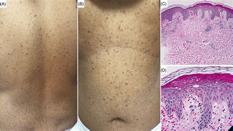 A Case Of Plc Showing A B Discrete Erythematous Papules With