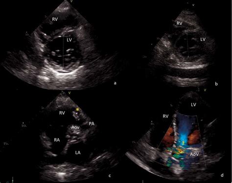 Transthoracic Echocardiography Images A Preoperative Short Axis View