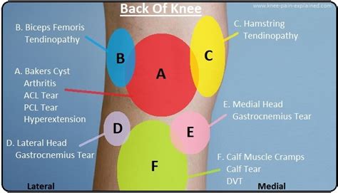 Knee Pain Diagnosis Chart - Knee Pain Explained