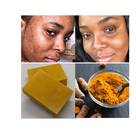 Turmeric Kojic Soap Dark Spot Remover Even Skin Tone Etsy