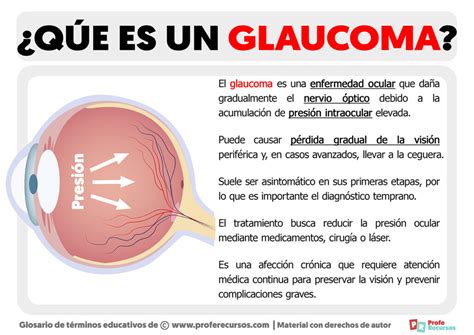 Qué es un Glaucoma Definición de Glaucoma