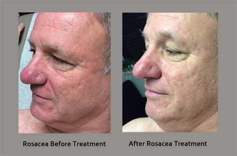 Rosacea, Sun Exposure, UV and Rosacea Treatment