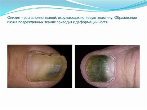 ЗАБОЛЕВАНИЯ НОГТЕЙ