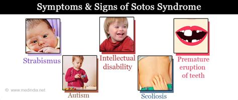 Sotos Syndrome Causes Symptoms Complications And Prognosis