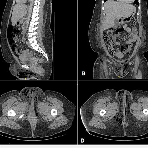 Ct Of Abdomen And Pelvis With Contrast Demonstrating Subcutaneous