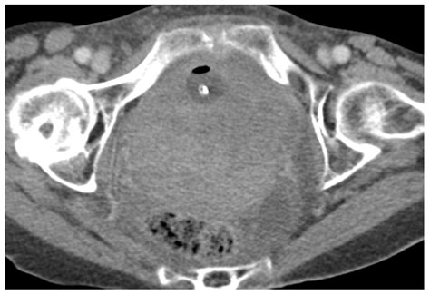 Cancers Free Full Text Urethral Mesh Assessment In Cancer Patients