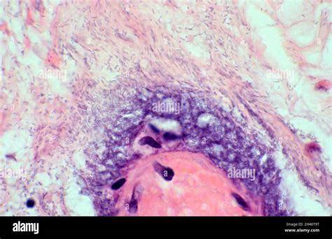 Pseudomonas Aeruginosa Rash