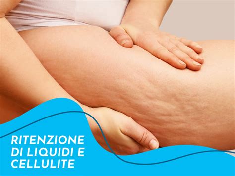 Cellulite E Ritenzione Idrica Cos Cause E Trattamenti