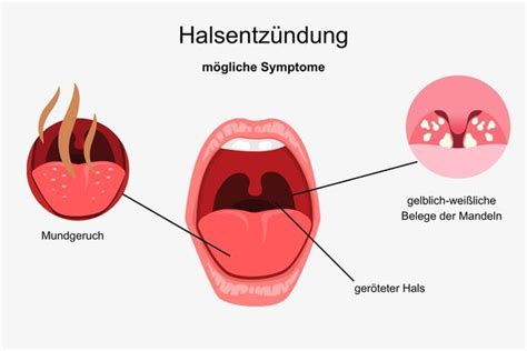 Halsentz Ndung Ursachen Symptome Und Behandlung Sieu Thi Do Noi That