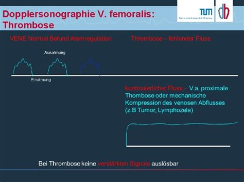 Thrombose Diagnostik Und Therapie Hintergrund Tiefe Venen Thrombose